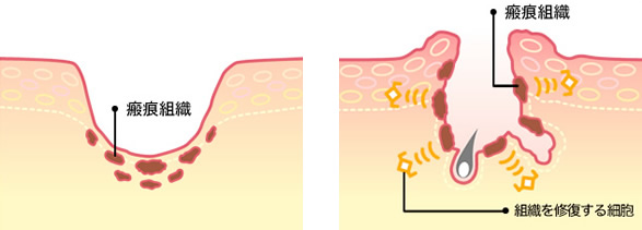 瘢痕組織が広がる