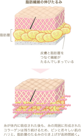 糸全体でたるみを支えるリードファインリフト