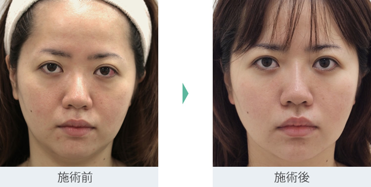 顔のたるみ（シワ・ほうれい線）- バッカルファット除去の症例写真