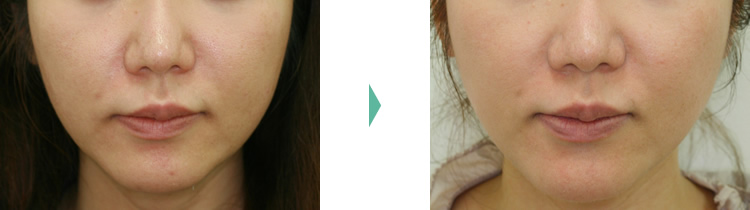 頬のたるみ -  ウルティマアンサンブルの症例写真