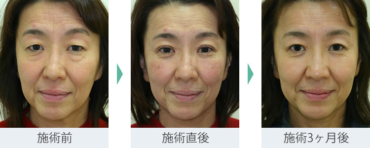 まぶた(たるみ・二重)- 2点埋没法の症例写真