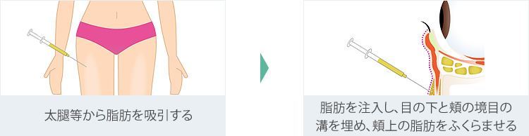 経結膜脱脂+リポトランスファー+脂肪注入
