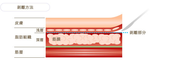 チークリフト 治療の仕組み