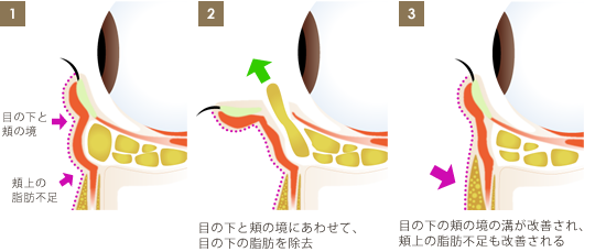 「出血」を抑える目の下の経結膜脱脂