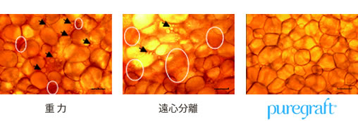 注入する脂肪の処理方法-目の下のクマ治療