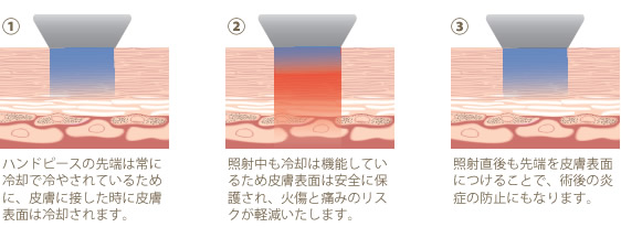 アルテミス・シェイプの冷却機能