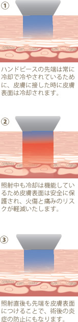 アルテミス・シェイプの冷却機能