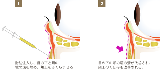 脂肪注入-目の下のクマ治療