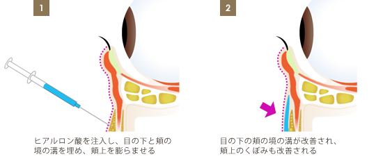 目の下のクマ-ヒアルロン酸の注入