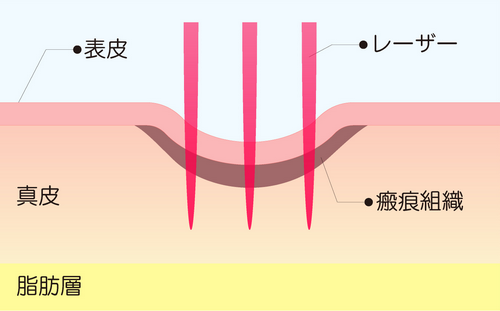 表皮内に作用させる