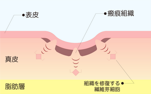 ニキビ跡 通常のレーザー治療（垂直フラクショナル治療）