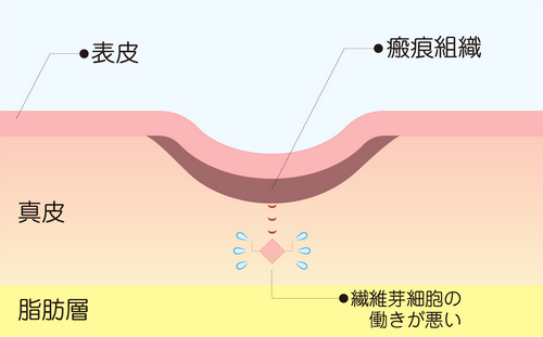 ニキビ跡ができやすい体質の人