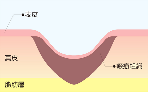 瘢痕組織が厚すぎる場合