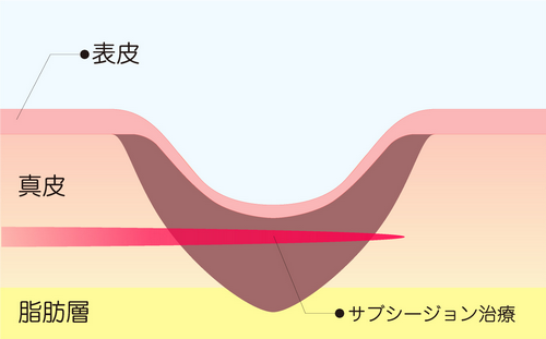 サブシジョン治療の仕組み