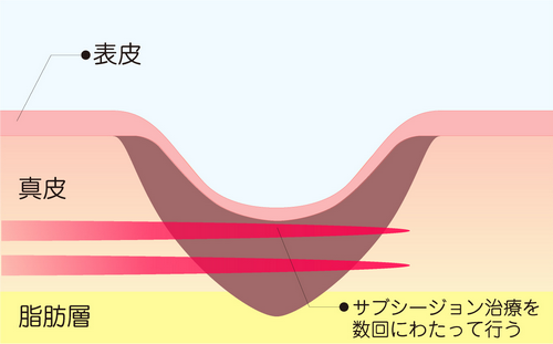 ニキビ跡 サブシジョン治療（水平フラクショナル治療）