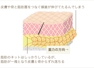 種類2:脂肪繊維の伸びによるたるみ