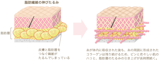 糸全体でたるみを支えるリードファインリフト