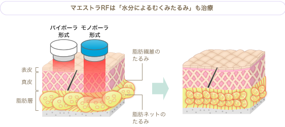 2種類のRFで、皮膚から脂肪層までしっかり届く