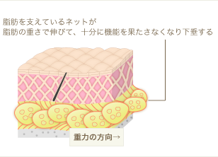 種類3:脂肪ネットの劣化によるたるみ