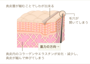 種類1:皮膚のハリ不足によるたるみ