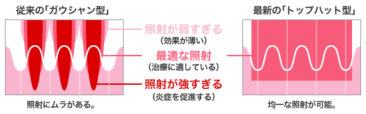 レーザートーニングの特殊な照射技術