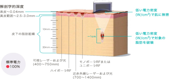 HIFU（ハイフ）を使って皮下脂肪にアプローチ