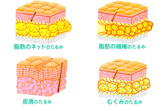 全てのたるみ種類に対応できます