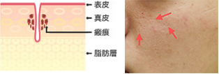 ニキビ跡 毛穴拡大タイプ