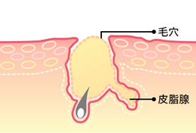 ニキビができる
