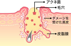 瘢痕組織が生まれる