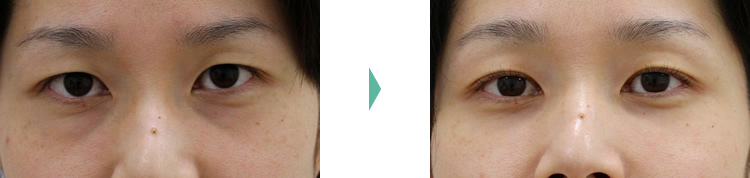 目の下のクマ・たるみ（膨らみ・凹み）- 経結膜脱脂+リポトランスファーの症例写真
